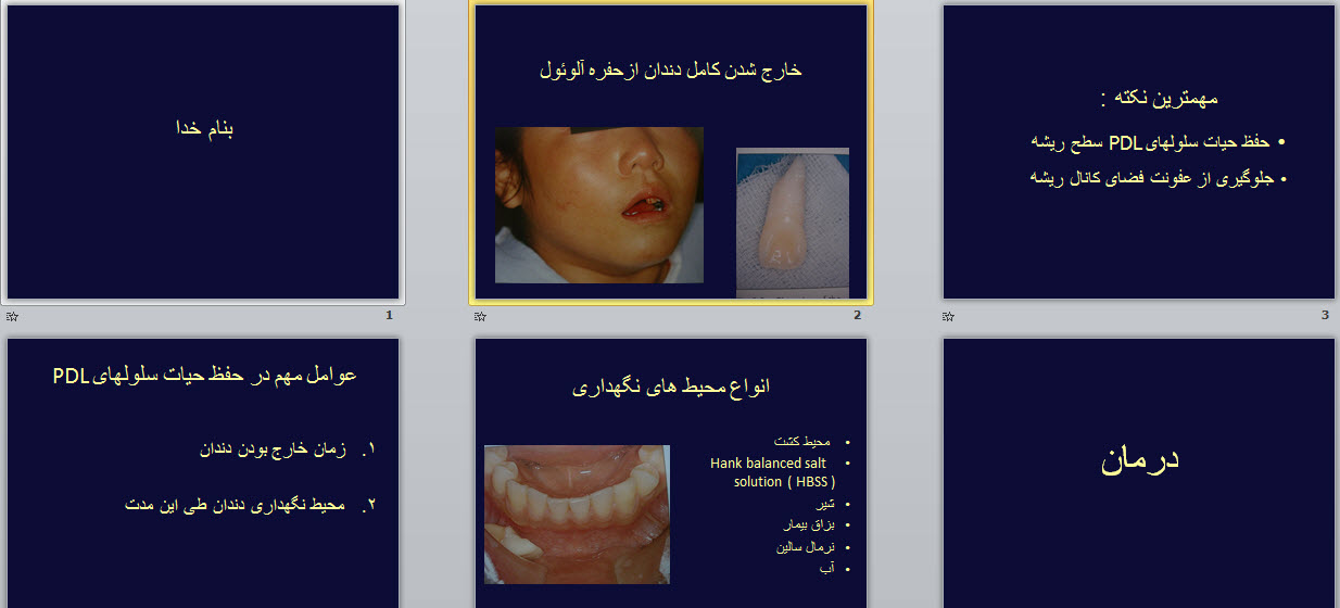 پاورپوینت خارج شدن کامل دندان ازحفره آلوئول