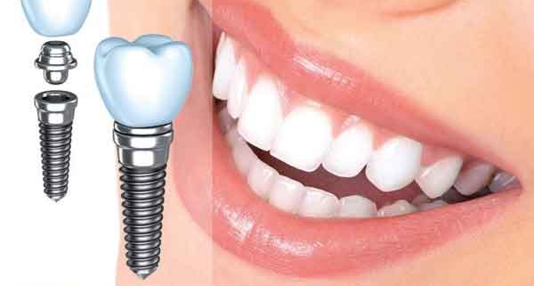 عواقب عدم کاشت دندان