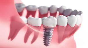 ایمپلنت دندان روشی برای بستن فاصله ی بین دندان ها.