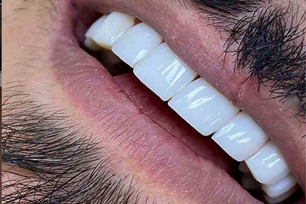 کامپوزیت دندان روشی برای اصلاح طرح لبخند است