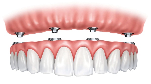 یکی از خدمات درمانی و زیبایی دندان، ایمپلنت است.