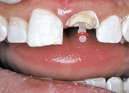 فایبر پست دندان چیست؟ fiberpost