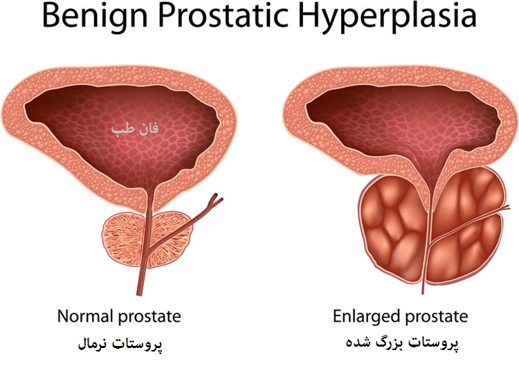 همه چیز درباره پروستات Prostate