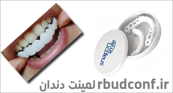 لمینت متحرک دندان