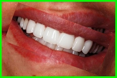 لمینت دندان متحرک چیه چیست ؟ لمینت دندان