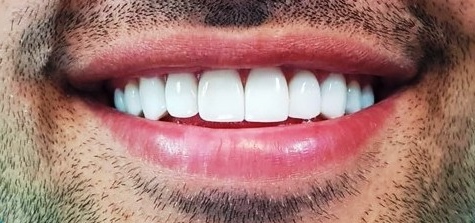بهترین نوع لمینت دندان چیست