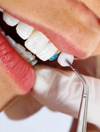 بهترین نوع لمینت دندان چیست