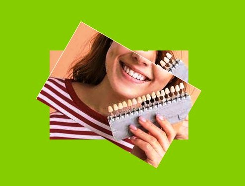 مزایای کامپوزیت لمینت دندان