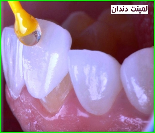 عکس لمینت دندان
