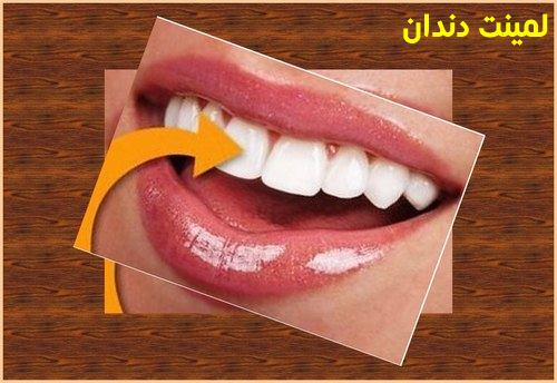 لمینت سرامیکی