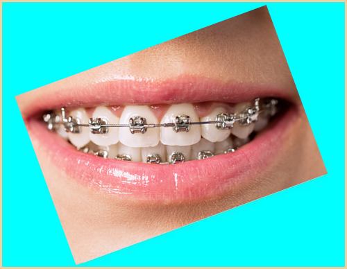 تفاوت بین لمینت و ارتودنسی