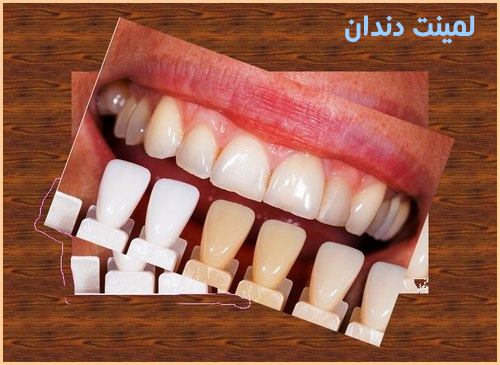 لمینت کامپوزیت