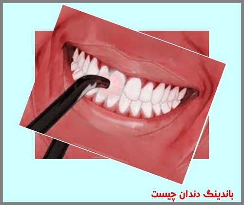 باندینگ دندان چیست