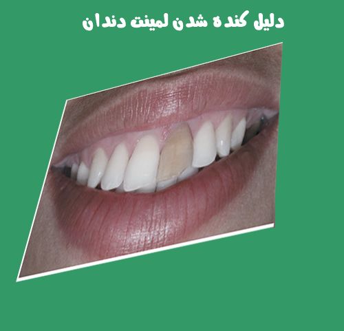 دلیل کنده شدن لمینت دندان چیه